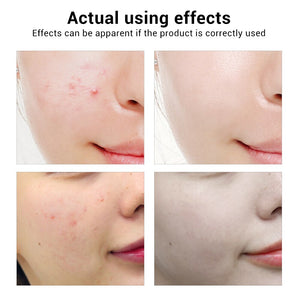Tea  Tree Essence Acne Treatment Serum